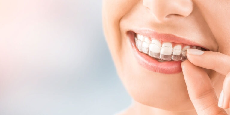 How Much Does Invisalign Cost in Torrance? What Changes the Price