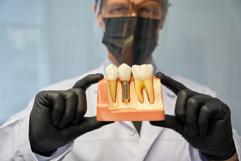 All-on-4 vs All-on-X: Choosing a Full Mouth Dental Implant Solution