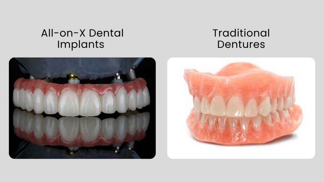 Comparison of All-on-X dental implants and traditional removable dentures