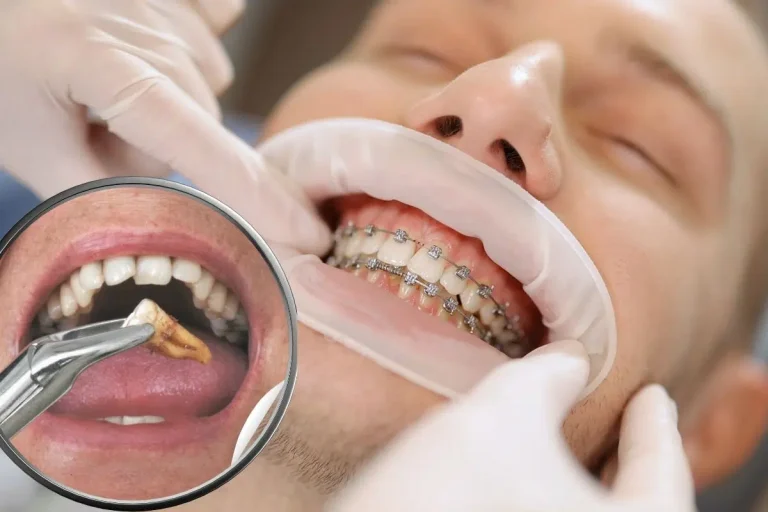 Wisdom Teeth Removal: Signs It’s Time, Recovery & Aftercare Tips