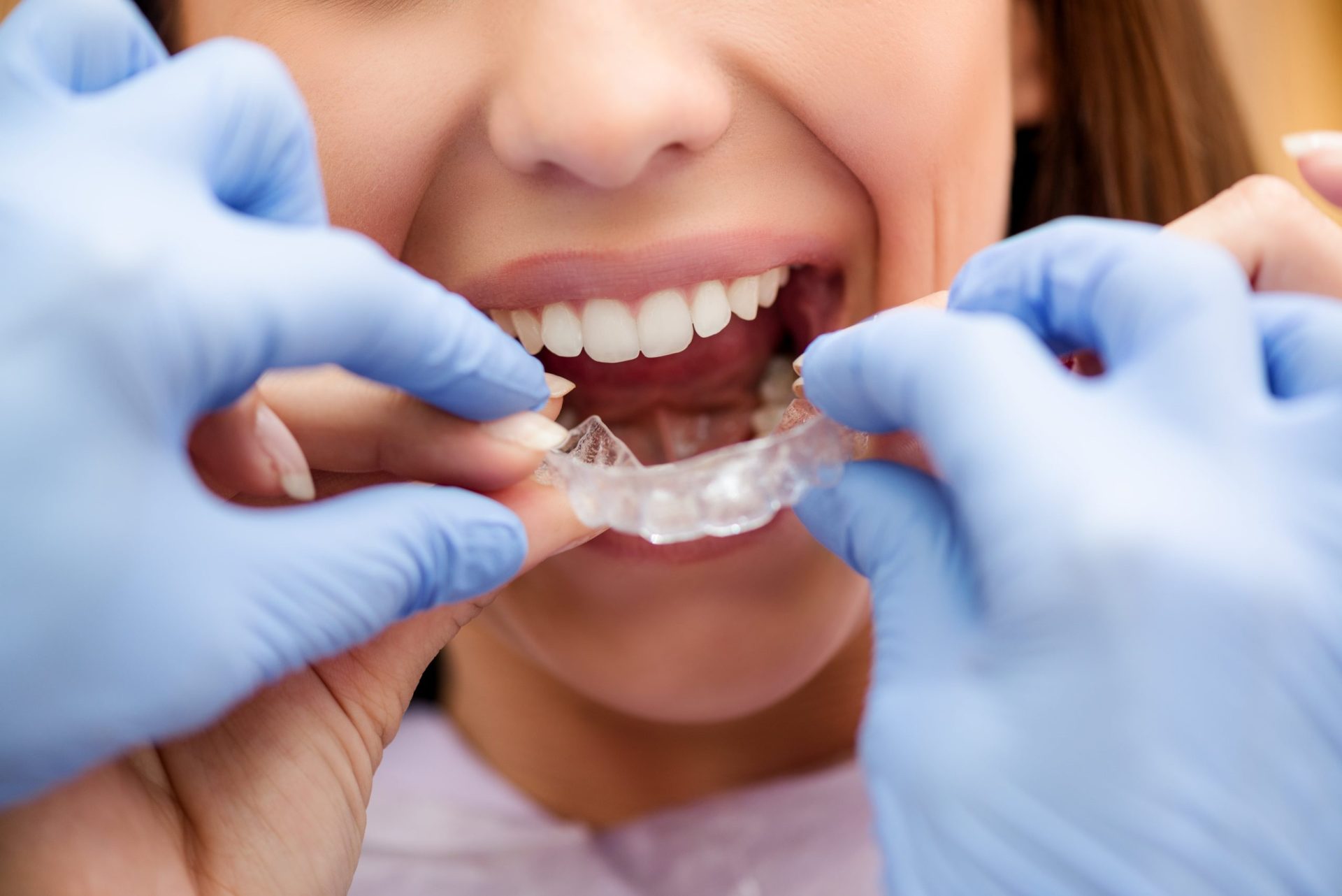 invisible-braces-2023-11-27-04-56-23-utc-min-scaled