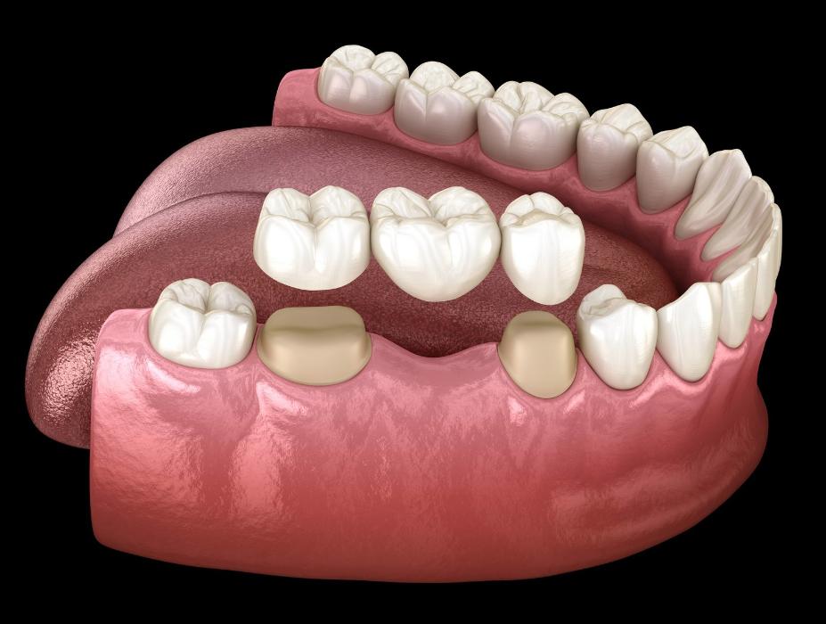 dental-bridge